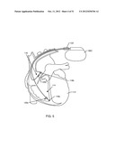 RF FILTER FOR AN ACTIVE MEDICAL DEVICE (AMD) FOR HANDLING HIGH RF POWER     INDUCED IN AN ASSOCIATED IMPLANTED LEAD FROM AN EXTERNAL RF FIELD diagram and image