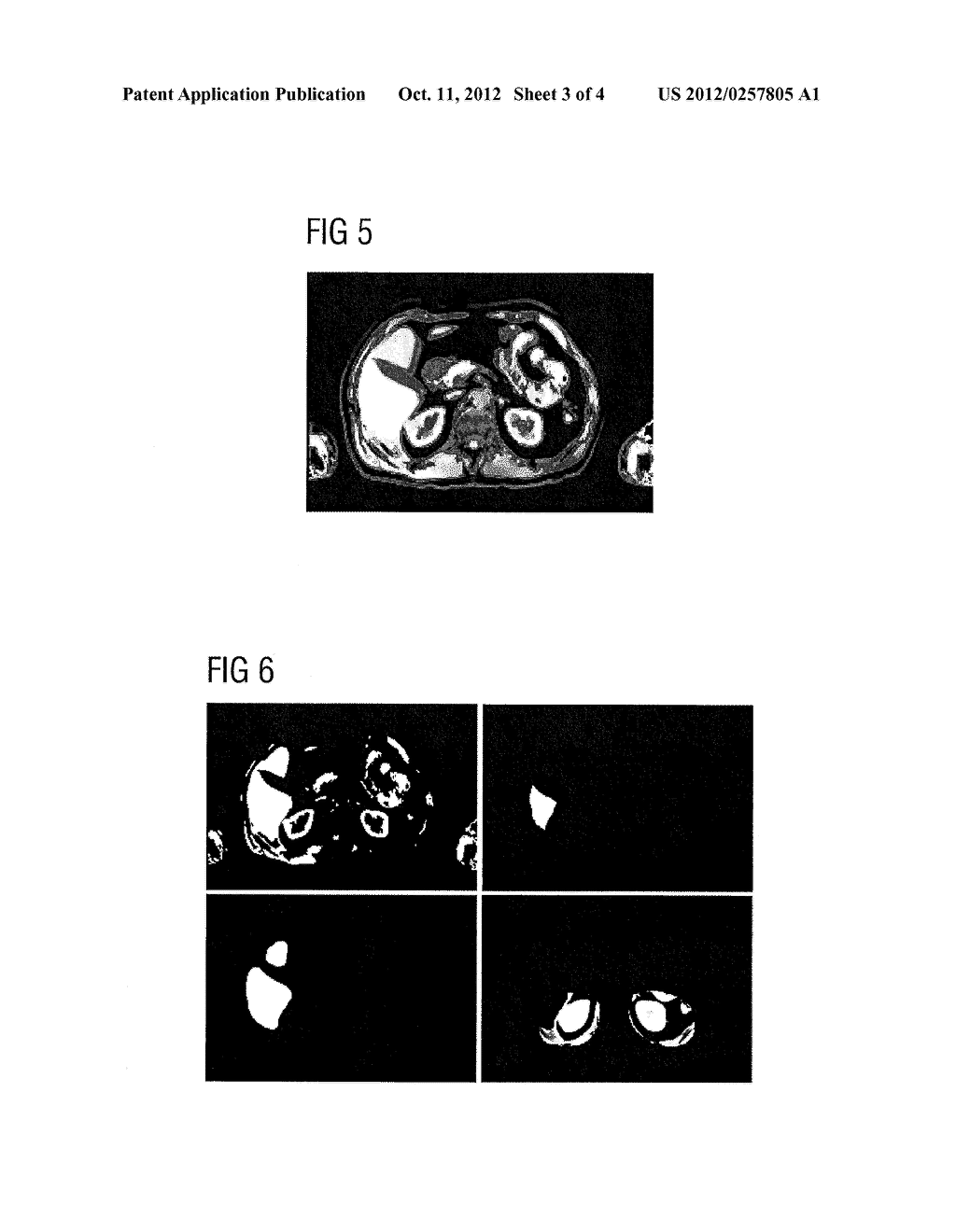 METHOD FOR THE FULLY AUTOMATIC SEGMENTATION OF AN ORGAN, IN PARTICULAR THE     RENAL PARENCHYMA, FROM VOLUME DATA SETS IN MEDICAL IMAGING - diagram, schematic, and image 04