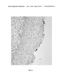 HUMAN PAPILLOMA VIRUS PROBES FOR THE DIAGNOSIS OF CANCER diagram and image