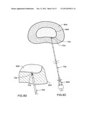 Method for Introducing Materials into a Body diagram and image