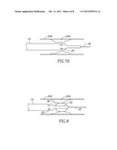 MICROCATHETER WITH DISTAL TIP PORTION AND PROXIMAL SOLUTION LUMEN diagram and image