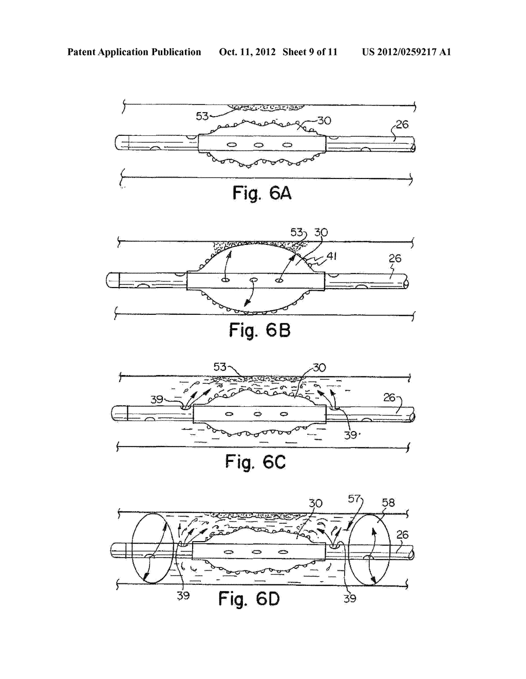 BIOFEEDBACK CONTROLLED DEFORMATION OF SINUS OSTIA - diagram, schematic, and image 10