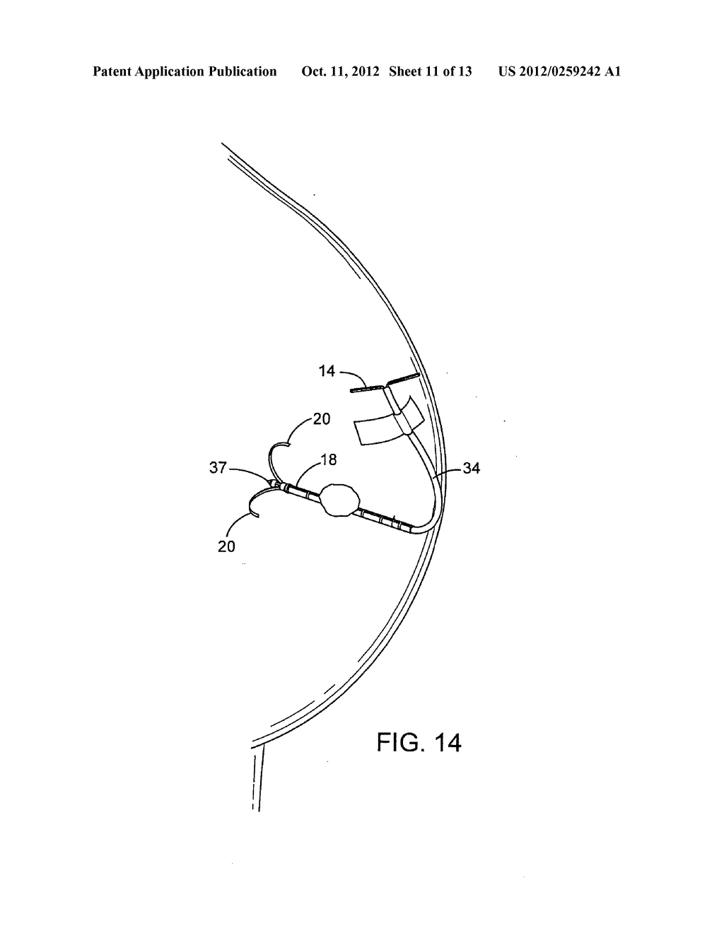 DEVICES AND METHODS FOR PERFORMING PROCEDURES ON A BREAST - diagram, schematic, and image 12