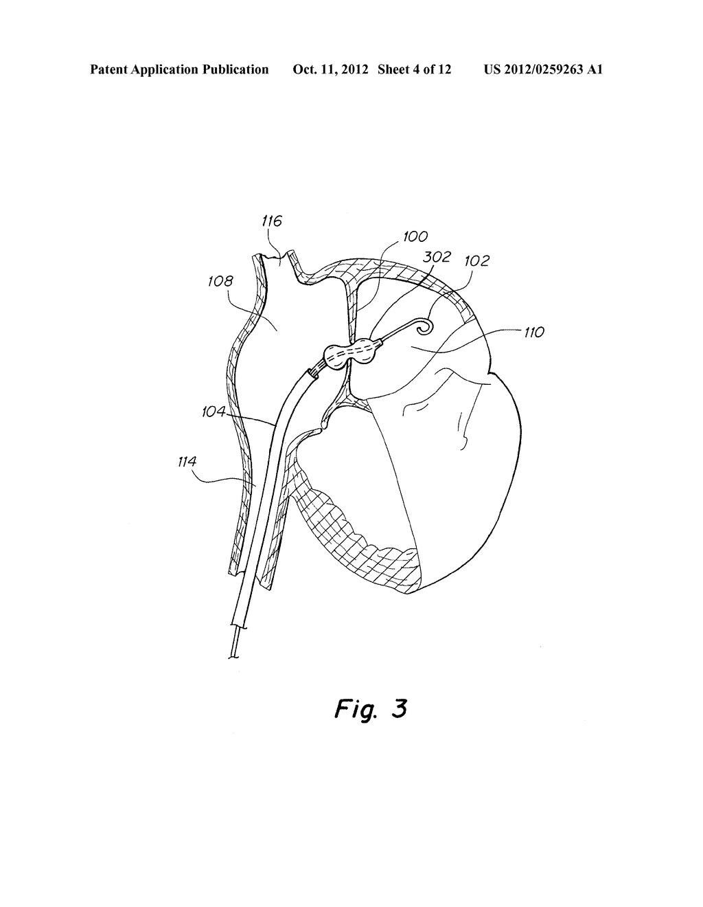 APPARATUS AND METHODS TO CREATE AND MAINTAIN AN INTRA-ATRIAL PRESSURE     RELIEF OPENING - diagram, schematic, and image 05