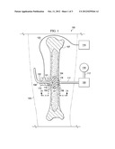 SYSTEMS FOR INDUCING FLUID FLOW TO STIMULATE TISSUE GROWTH diagram and image