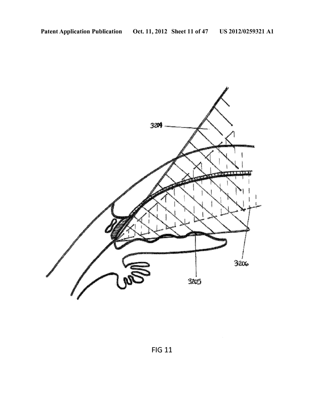 Systems and methods to deliver photodisruptive laser pulses into tissue     layers of the anterior angle of the eye - diagram, schematic, and image 12