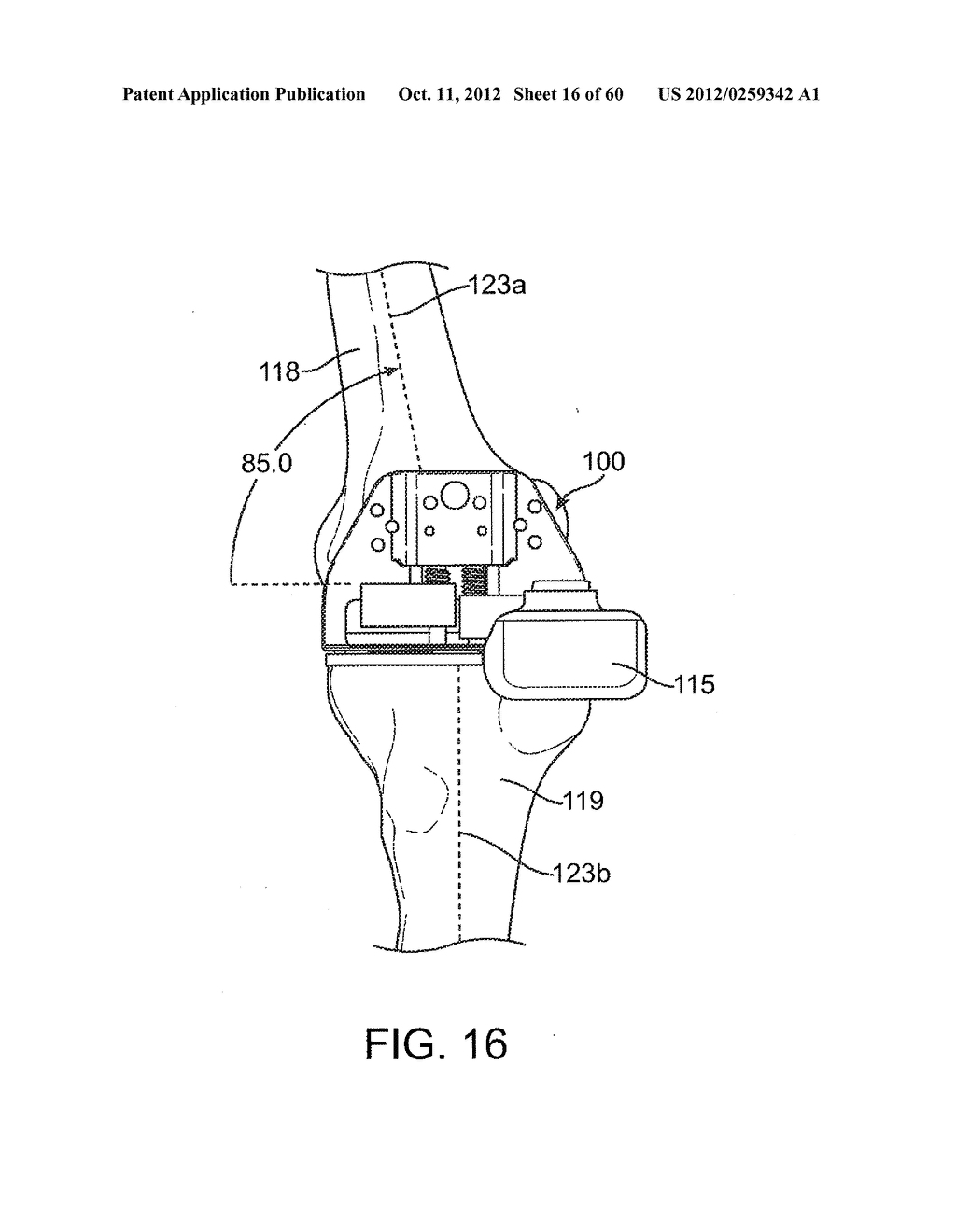 SYSTEM FOR POSITIONING A CUTTING GUIDE IN KNEE SURGERY - diagram, schematic, and image 17