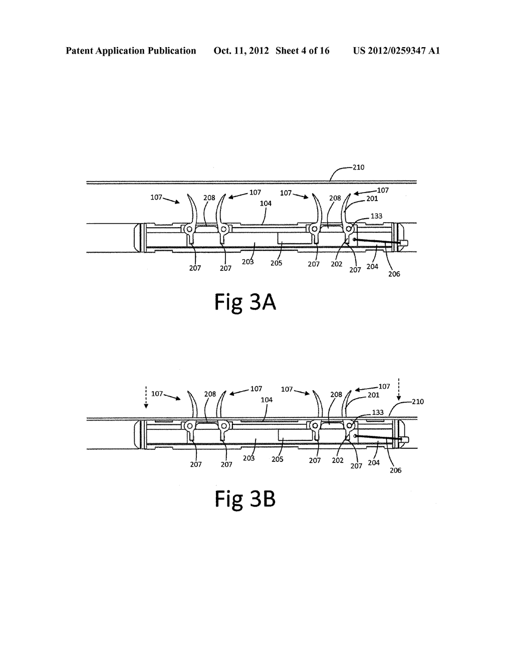 Biocompatible Sleeve for Mesh Insertion Instrument - diagram, schematic, and image 05