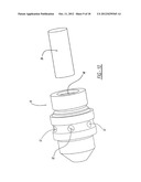 FACET FUSION IMPLANT, INSTRUMENTATION, AND SURGICAL PROCEDURE diagram and image