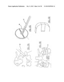 FACET FUSION IMPLANT, INSTRUMENTATION, AND SURGICAL PROCEDURE diagram and image