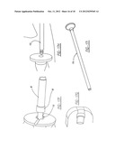 FACET FUSION IMPLANT, INSTRUMENTATION, AND SURGICAL PROCEDURE diagram and image