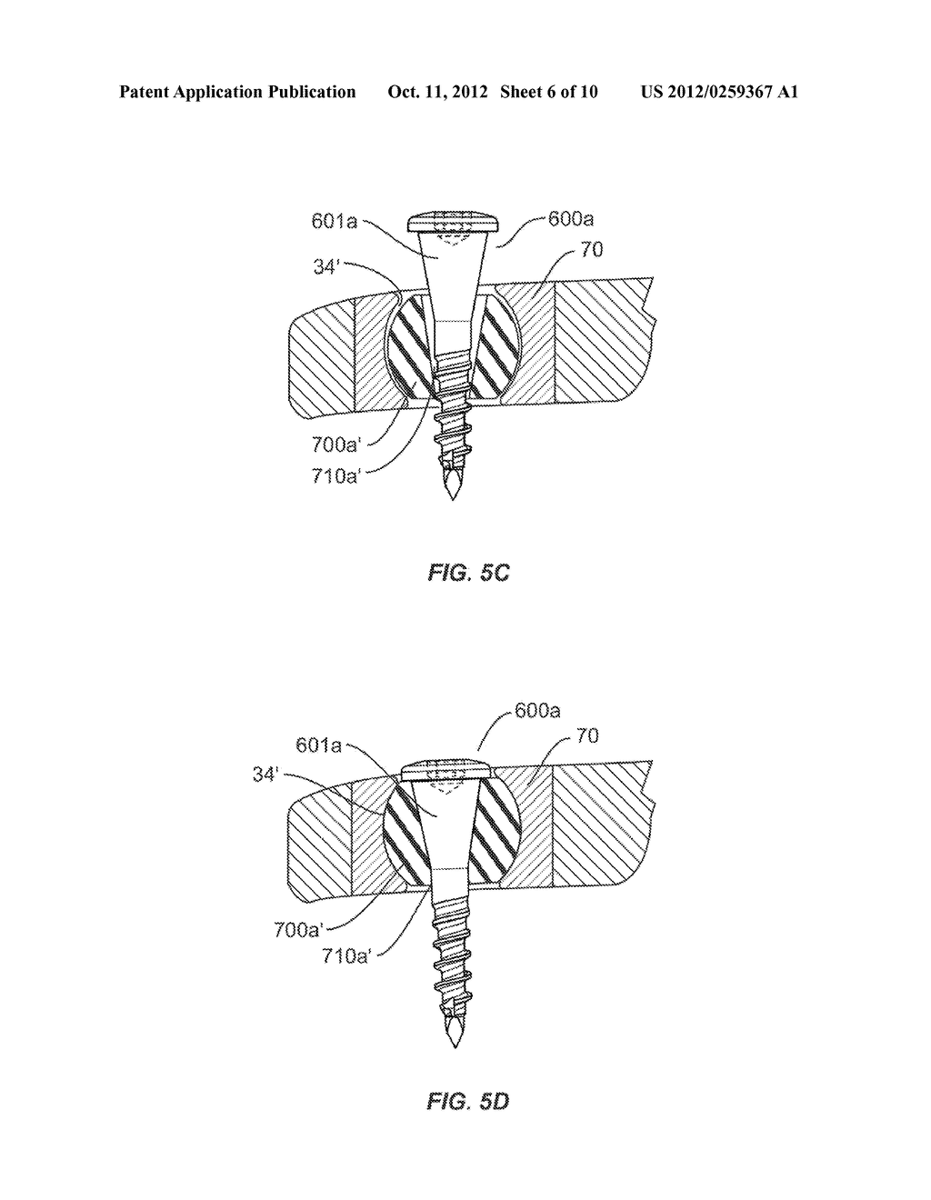 LUMBAR-SACRAL IMPLANT ALLOWING VARIABLE ANGLE FIXATION - diagram, schematic, and image 07