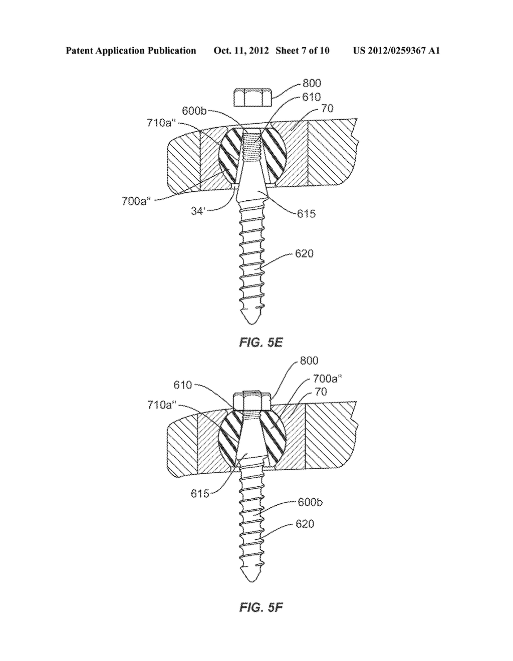 LUMBAR-SACRAL IMPLANT ALLOWING VARIABLE ANGLE FIXATION - diagram, schematic, and image 08