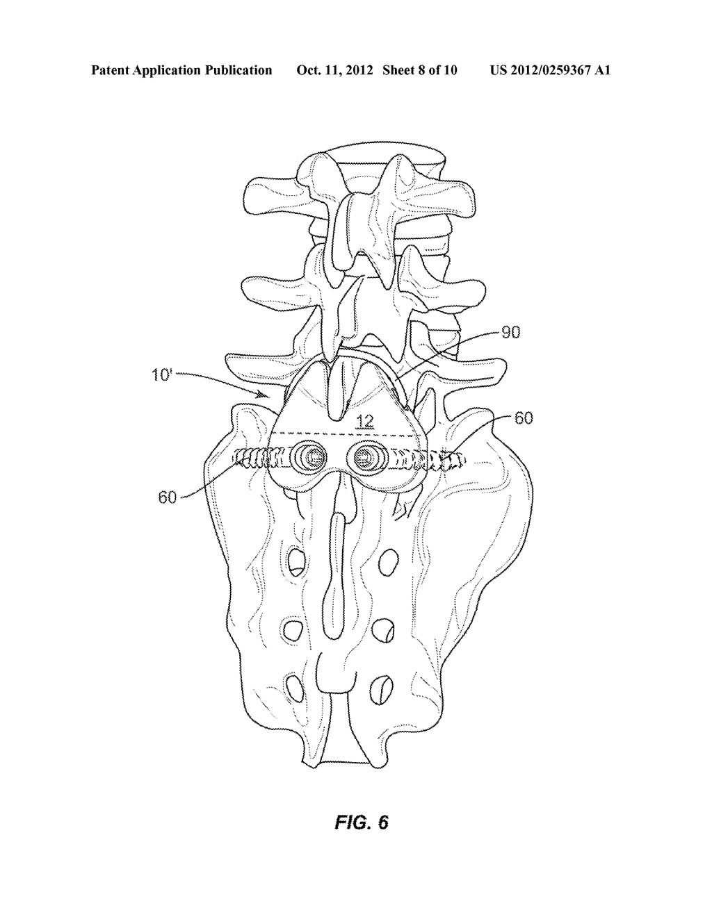 LUMBAR-SACRAL IMPLANT ALLOWING VARIABLE ANGLE FIXATION - diagram, schematic, and image 09