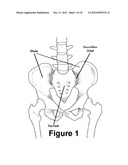 Method for Minimally Invasive Treatment of Unstable Pelvic Ring Injuries diagram and image