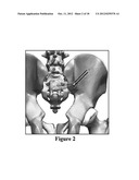 Method for Minimally Invasive Treatment of Unstable Pelvic Ring Injuries diagram and image