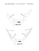 Method for Minimally Invasive Treatment of Unstable Pelvic Ring Injuries diagram and image