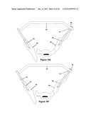 Method for Minimally Invasive Treatment of Unstable Pelvic Ring Injuries diagram and image