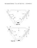 Method for Minimally Invasive Treatment of Unstable Pelvic Ring Injuries diagram and image