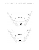 Method for Minimally Invasive Treatment of Unstable Pelvic Ring Injuries diagram and image