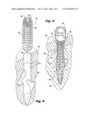 ORTHOPEDIC SCREW INSERT diagram and image