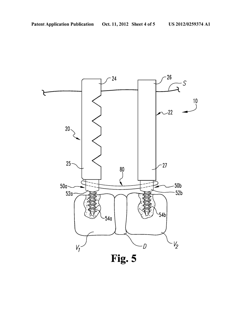 Flexible Anchor Extenders - diagram, schematic, and image 05