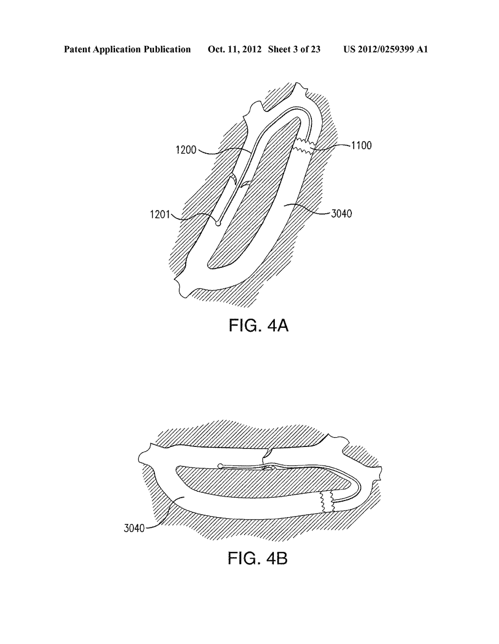 INTRALUMINAL SCAFFOLD SYSTEM AND USE THEREOF - diagram, schematic, and image 04