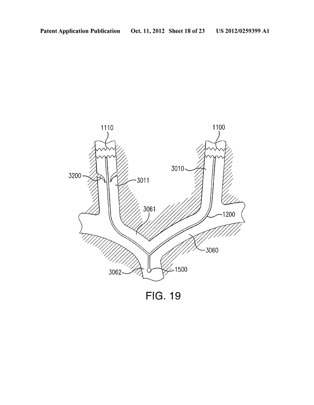 INTRALUMINAL SCAFFOLD SYSTEM AND USE THEREOF - diagram, schematic, and image 19