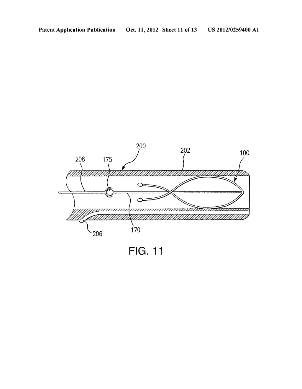 FLEXIBLE INTRALUMINAL SCAFFOLD - diagram, schematic, and image 12