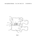 LATERALLY EXPANDABLE INTERBODY SPINAL FUSION IMPLANT diagram and image