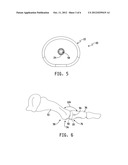 METHOD AND APPARATUS FOR THE TREATMENT OF METATARSOPHALANGEAL JOINT     DEGENERATIVE ARTHRITIS diagram and image