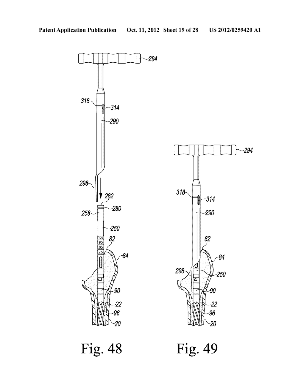 PROXIMAL TRIAL INSTRUMENT FOR USE DURING AN ORTHOPAEDIC SURGICAL PROCEDURE     TO IMPLANT A REVISION HIP PROSTHESIS - diagram, schematic, and image 20