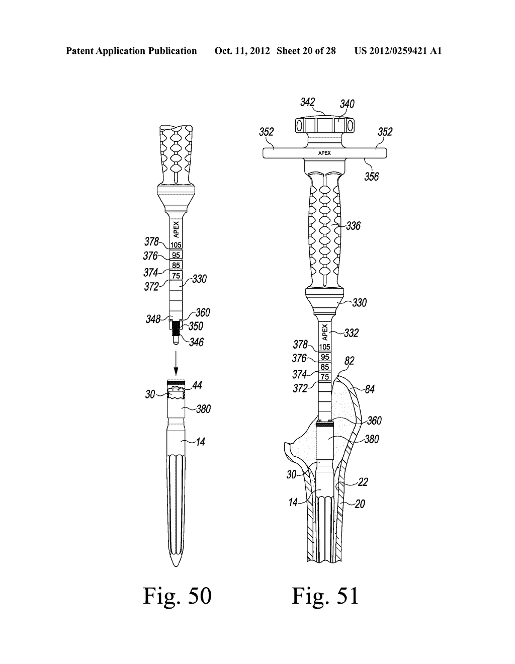 VERSION-REPLICATING INSTRUMENT AND ORTHOPAEDIC SURGICAL PROCEDURE FOR     USING THE SAME TO IMPLANT A REVISION HIP PROSTHESIS - diagram, schematic, and image 21