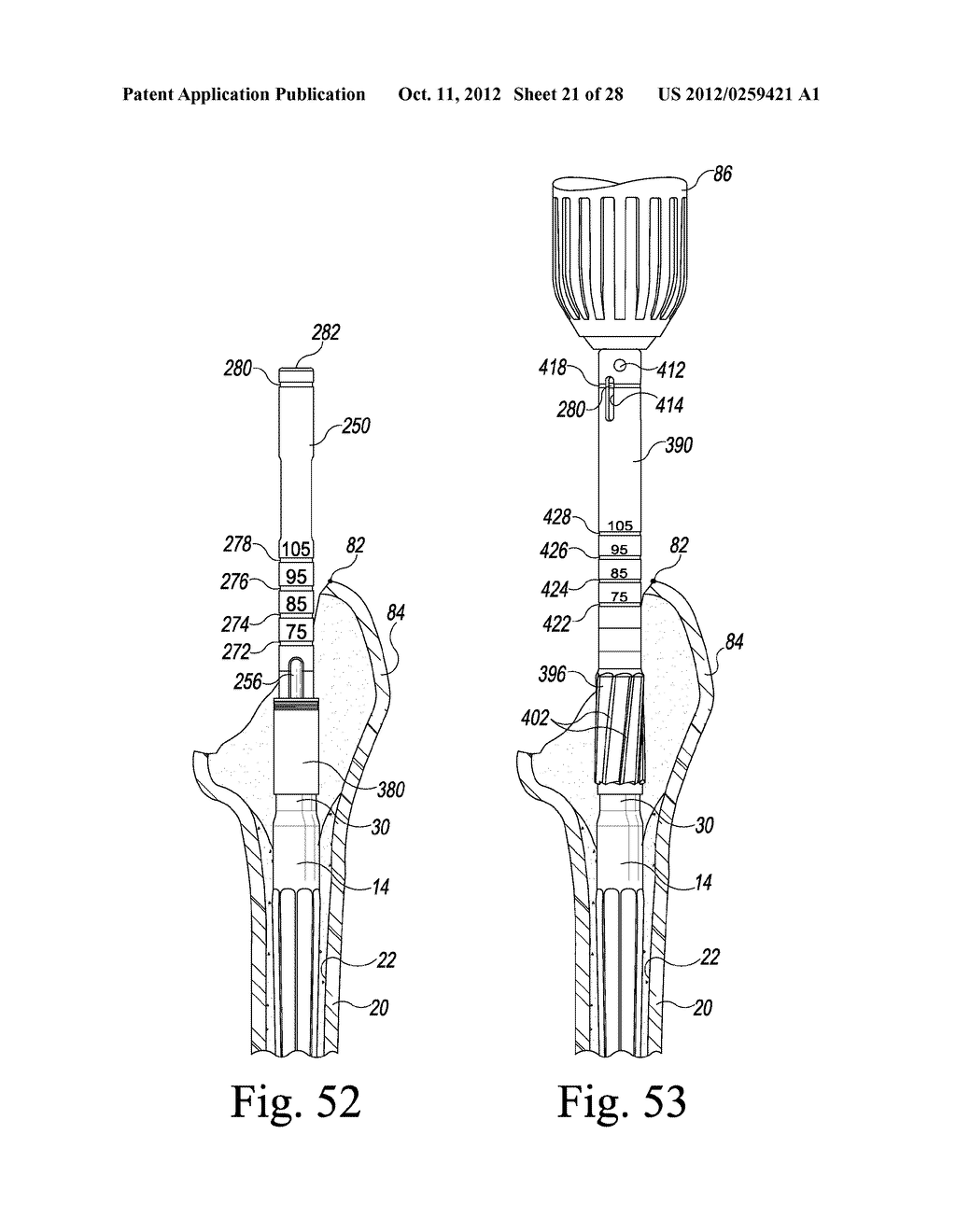 VERSION-REPLICATING INSTRUMENT AND ORTHOPAEDIC SURGICAL PROCEDURE FOR     USING THE SAME TO IMPLANT A REVISION HIP PROSTHESIS - diagram, schematic, and image 22