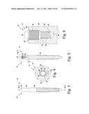 ORTHOPAEDIC SURGICAL PROCEDURE FOR IMPLANTING A REVISION HIP PROSTHESIS diagram and image