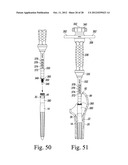 ORTHOPAEDIC SURGICAL PROCEDURE FOR IMPLANTING A REVISION HIP PROSTHESIS diagram and image