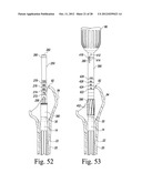 ORTHOPAEDIC SURGICAL PROCEDURE FOR IMPLANTING A REVISION HIP PROSTHESIS diagram and image