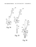 ORTHOPAEDIC SURGICAL PROCEDURE FOR IMPLANTING A REVISION HIP PROSTHESIS diagram and image