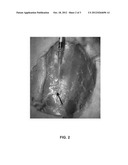 METHODS OF USING BASIC FIBROBLAST GROWTH FACTOR TO PREVENT ACUTE WOUND     FAILURE diagram and image