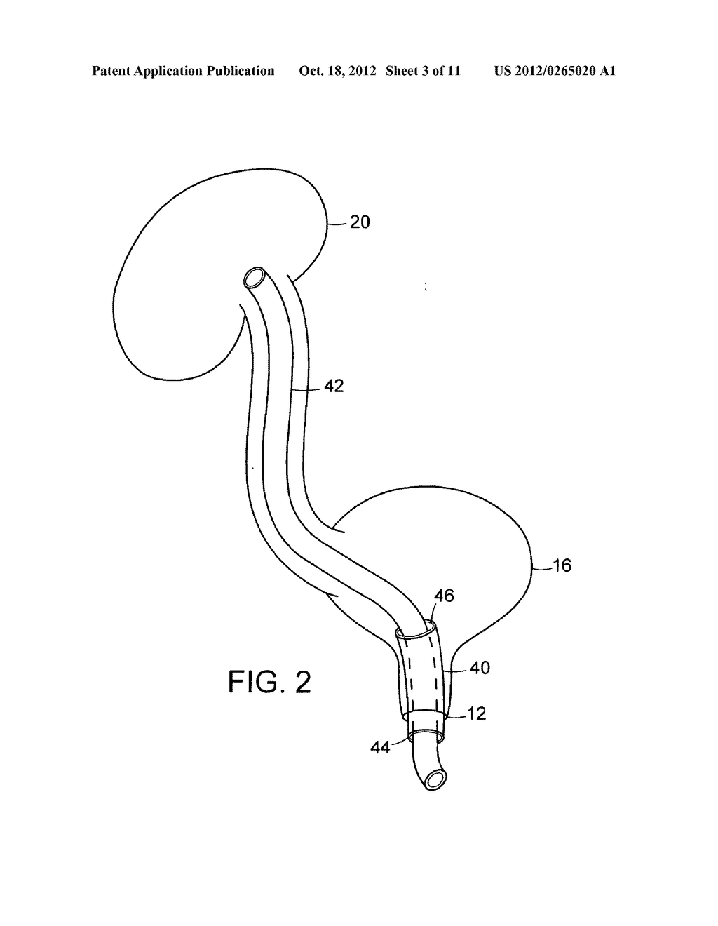 ACCESS AND DRAINAGE DEVICES AND METHODS OF USE THEREOF - diagram, schematic, and image 04