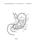 DEVICES, SYSTEMS, KITS AND METHODS FOR TREATMENT OF OBESITY diagram and image