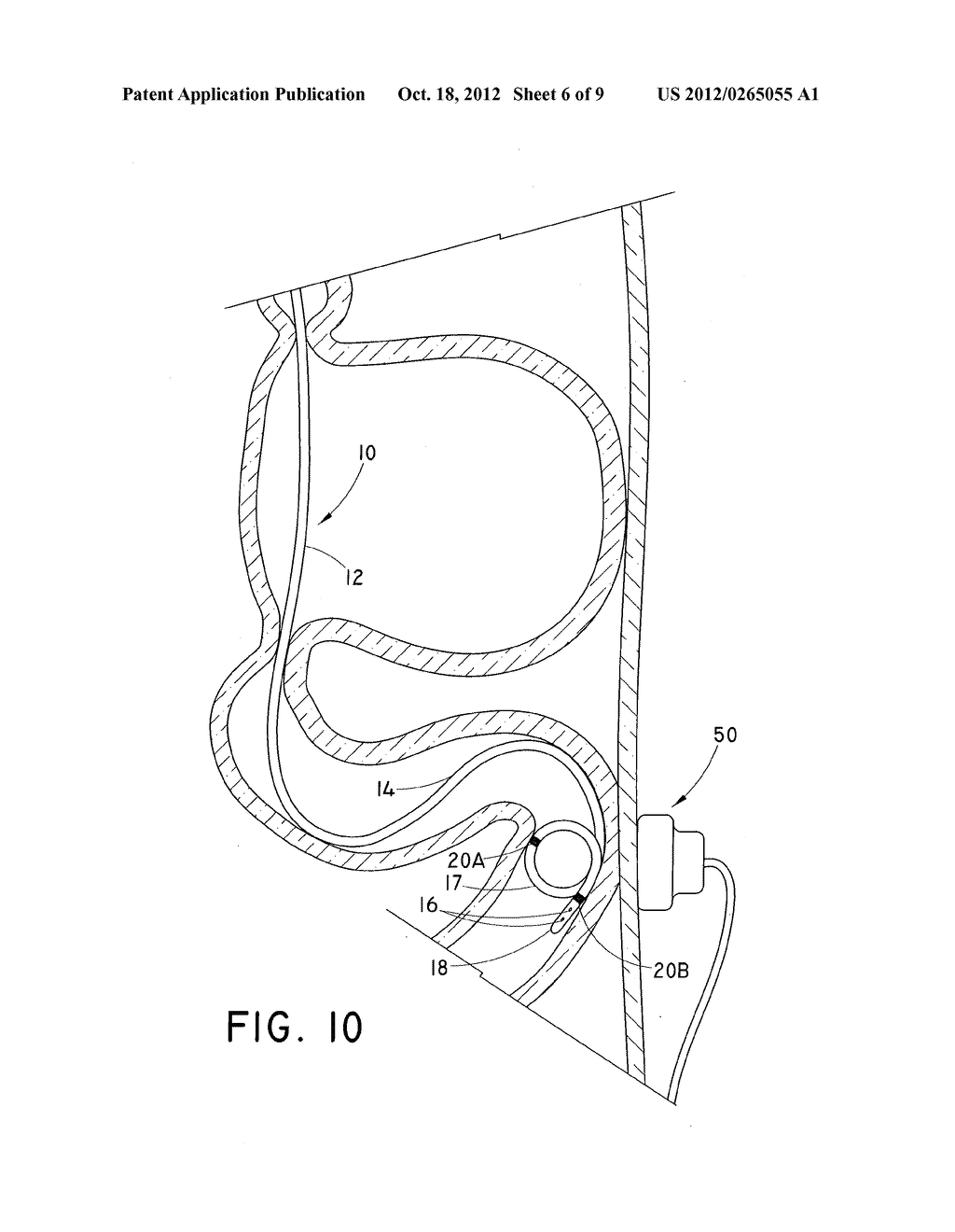 TUBULAR FEEDING DEVICE HAVING SHAPEABLE DISTAL END - diagram, schematic, and image 07