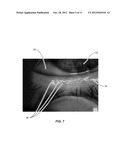 METHODS FOR DIAGNOSING MEIBOMIAN GLAND DYSFUNCTION diagram and image