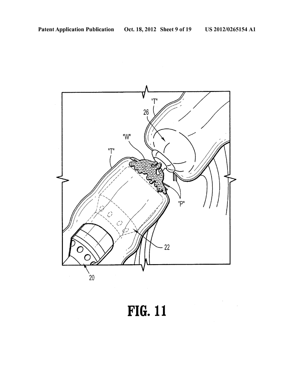 Surgical Apparatus and Structure for Applying Sprayable Wound Treatment     Material - diagram, schematic, and image 10