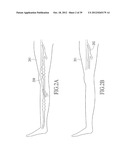 ENDOVENOUS LASER TREATMENT GENERATING REDUCED BLOOD COAGULATION diagram and image