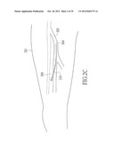 ENDOVENOUS LASER TREATMENT GENERATING REDUCED BLOOD COAGULATION diagram and image