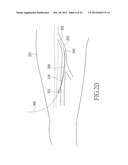 ENDOVENOUS LASER TREATMENT GENERATING REDUCED BLOOD COAGULATION diagram and image