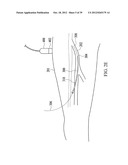 ENDOVENOUS LASER TREATMENT GENERATING REDUCED BLOOD COAGULATION diagram and image