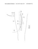 ENDOVENOUS LASER TREATMENT GENERATING REDUCED BLOOD COAGULATION diagram and image