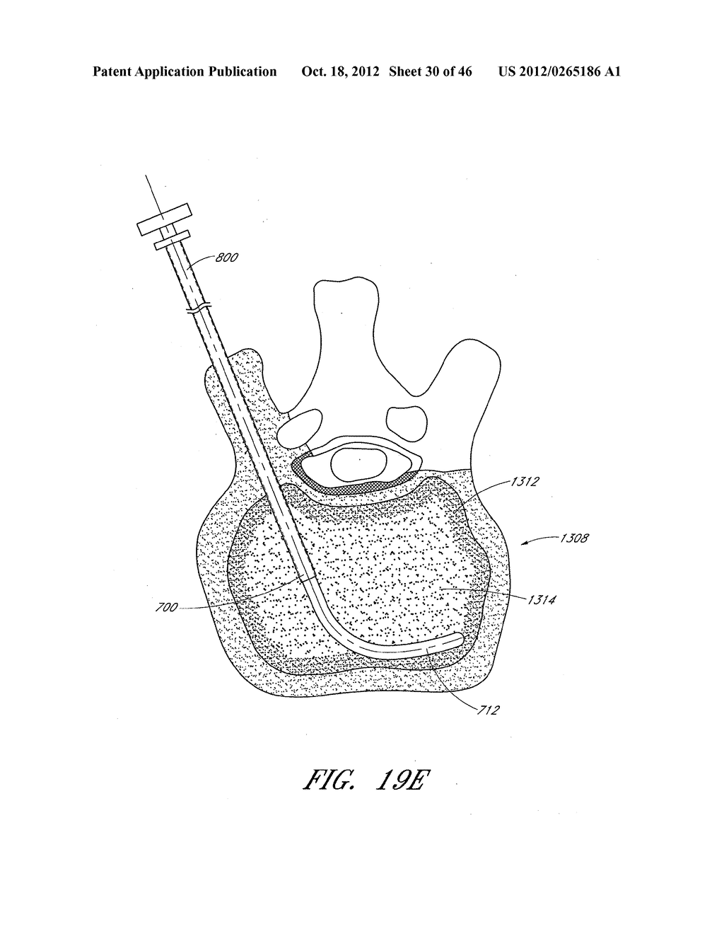 STEERABLE CURVABLE ABLATION CATHETER FOR VERTEBROPLASTY - diagram, schematic, and image 31